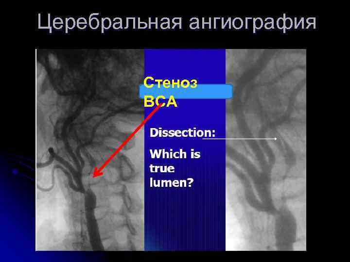 Церебральная ангиография Стеноз ВСА 