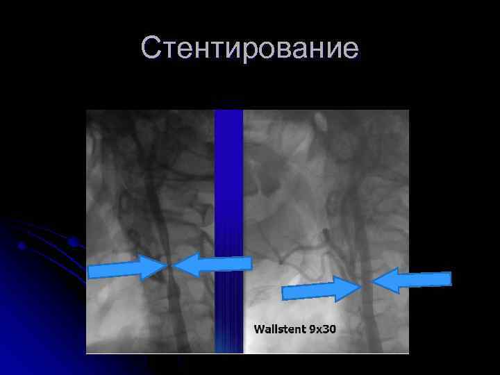 Стентирование 