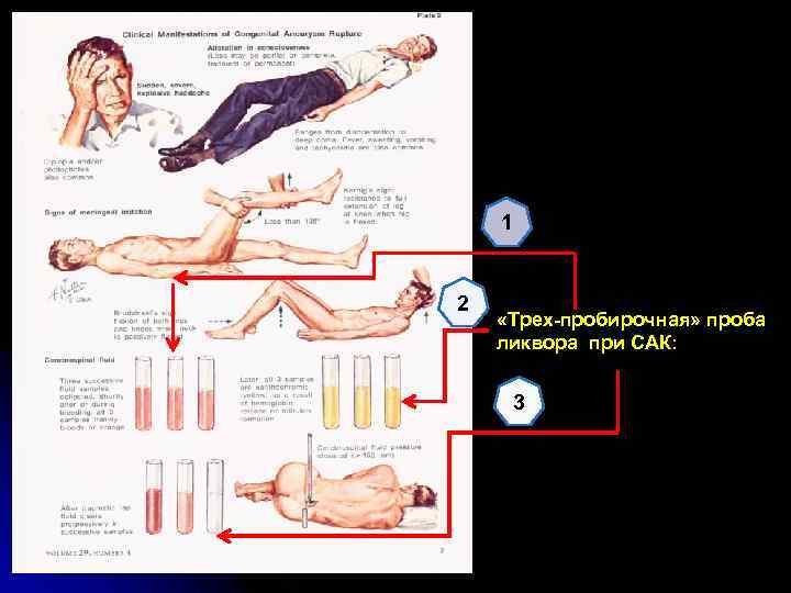 1 2 «Трех-пробирочная» проба ликвора при САК: 3 