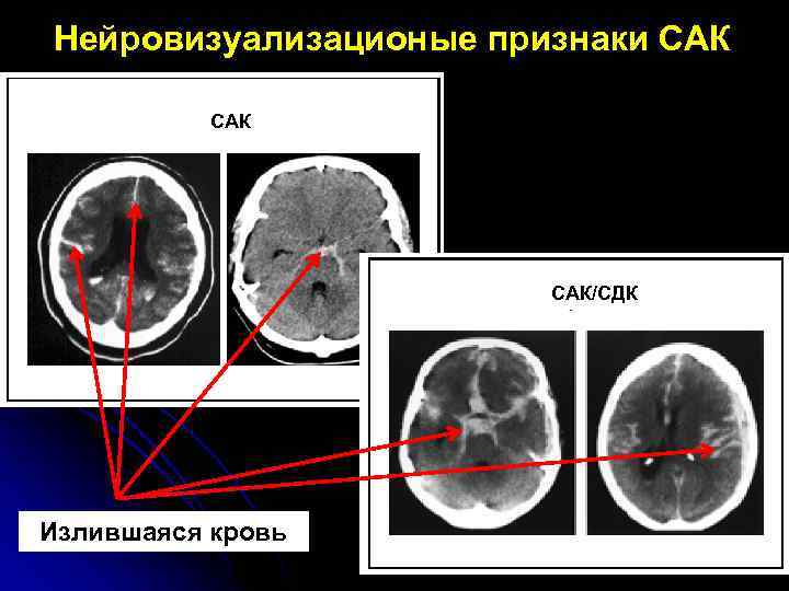 Сак лечение. Признаки Сак головного мозга. Клинические признаки Сак.