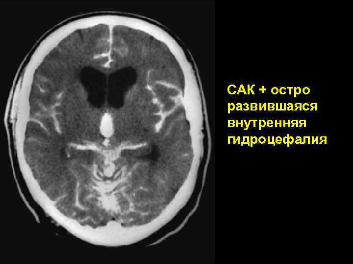 САК + остро развившаяся внутренняя гидроцефалия 