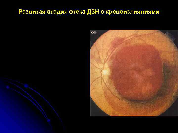 Развитая стадия отека ДЗН с кровоизлияниями Subhyaloid hemorrhage Flame and dot hemorrhages 