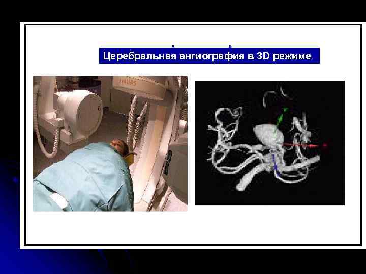 Церебральная ангиография в 3 D режиме 