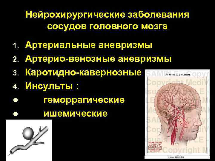 Нейрохирургические заболевания сосудов головного мозга 1. 2. 3. 4. l l Артериальные аневризмы Артерио-венозные