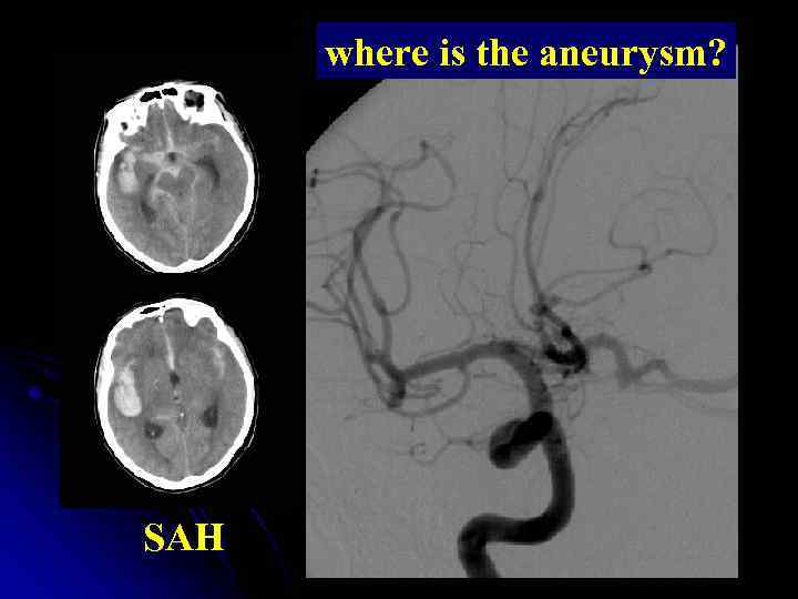 where is the aneurysm? SAH 