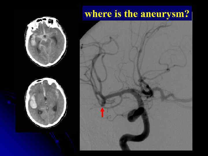 where is the aneurysm? 