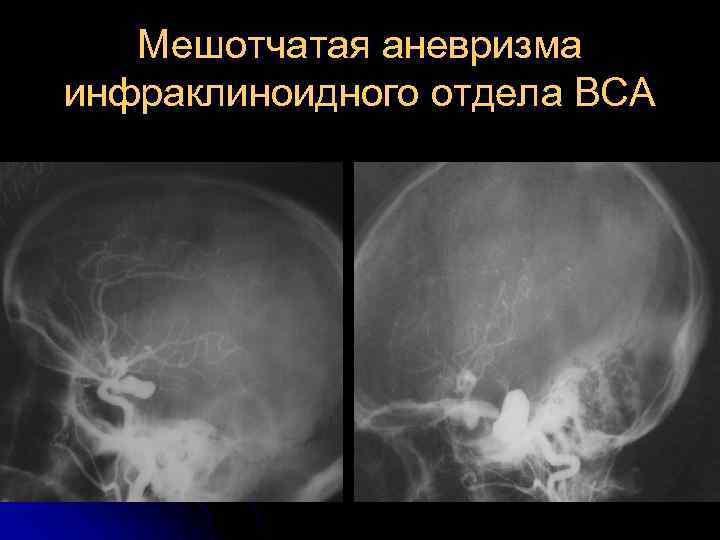 Мешотчатая аневризма инфраклиноидного отдела ВСА 