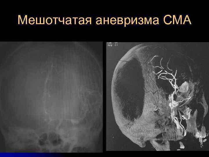 Мешотчатая аневризма