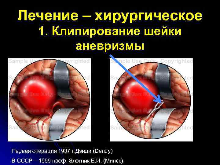 Лечение – хирургическое 1. Клипирование шейки аневризмы Первая операция 1937 г. Дэнди (Dendy) В