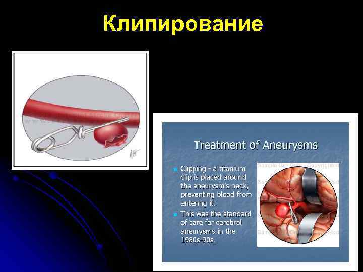 Клипирование 