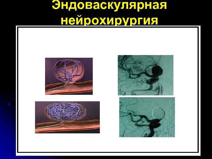 Эндоваскулярная нейрохирургия 