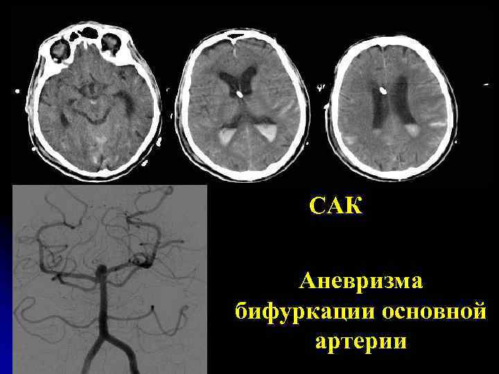 САК Аневризма бифуркации основной артерии 