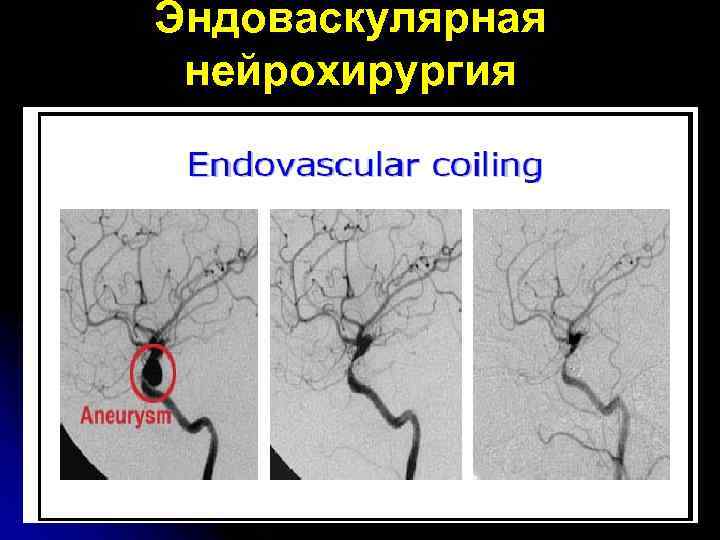 Эндоваскулярная нейрохирургия 