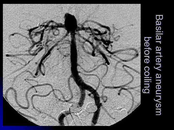 Basilar artery aneurysm before coiling 