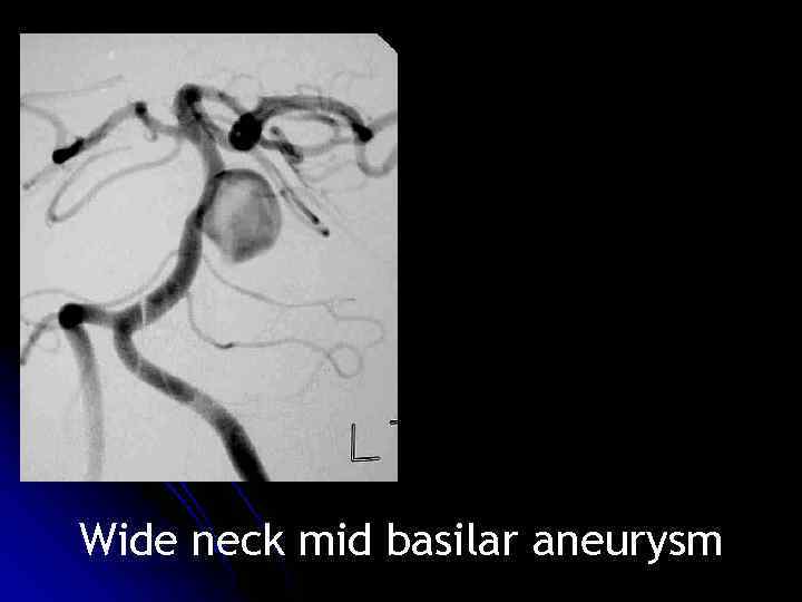 Wide neck mid basilar aneurysm 