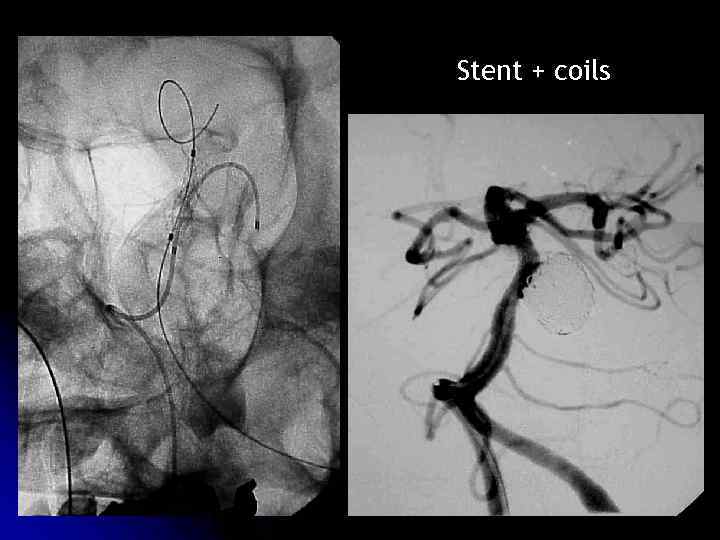 Stent + coils 