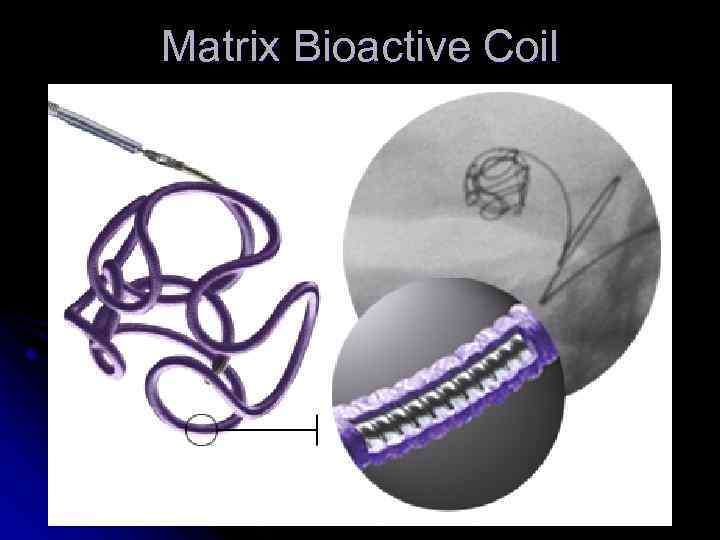 Matrix Bioactive Coil 