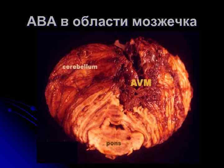 АВА в области мозжечка 