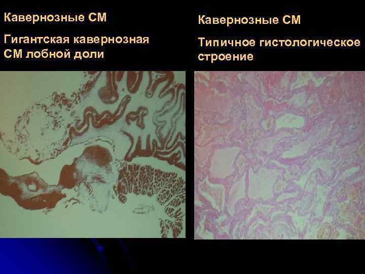 Кавернозные СМ Гигантская кавернозная СМ лобной доли Типичное гистологическое строение 