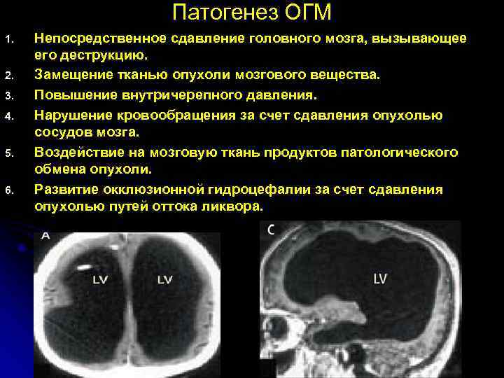 Виды опухолей головного