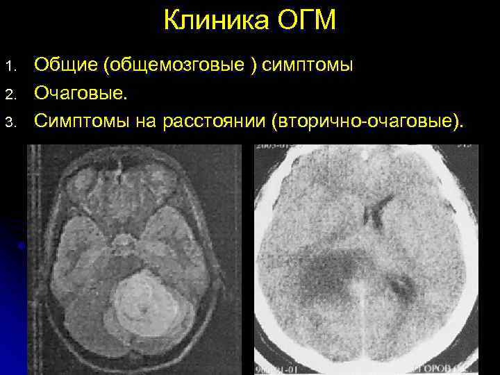    Клиника ОГМ 1.  Общие (общемозговые ) симптомы 2.  Очаговые.