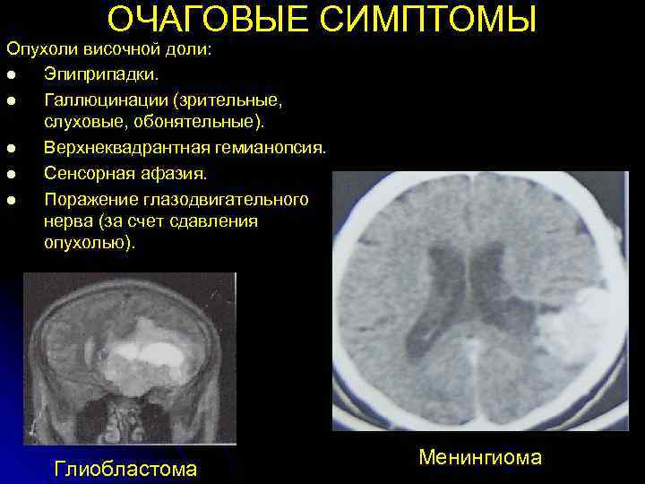 Проявления опухоли головного мозга