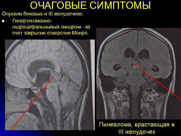    ОЧАГОВЫЕ СИМПТОМЫ Опухоли боковых и III желудочков: l  Гипертензионно- гидроцефальныйый