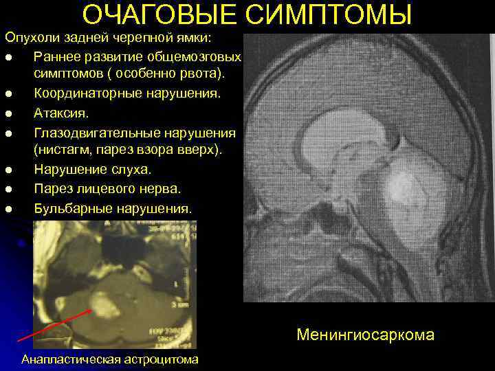   ОЧАГОВЫЕ СИМПТОМЫ Опухоли задней черепной ямки: l  Раннее развитие общемозговых симптомов