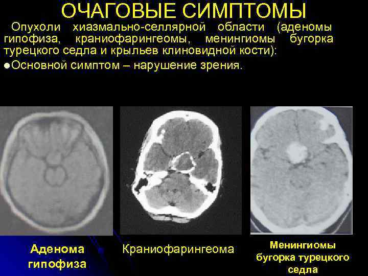   ОЧАГОВЫЕ СИМПТОМЫ  Опухоли хиазмально-селлярной области (аденомы гипофиза, краниофарингеомы, менингиомы бугорка турецкого