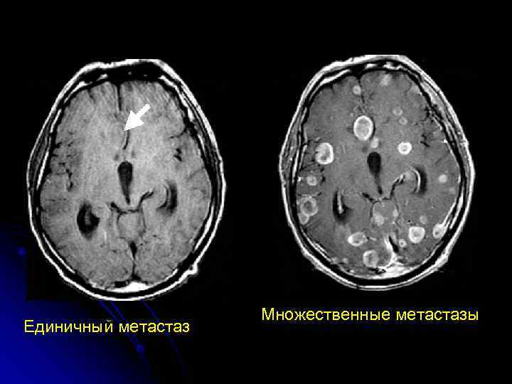 Метастазы в головном мозге симптомы