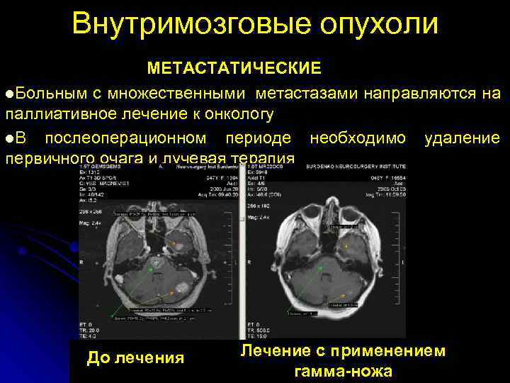   Внутримозговые опухоли   МЕТАСТАТИЧЕСКИЕ l. Больным с множественными метастазами направляются на