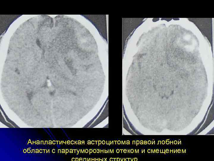 Астроцитома головного мозга прогноз жизни после операции. Анапластическая астроцитома кт. Анапластическая астроцитома лобной доли. Астроцитома головного мозга кт. Диффузная астроцитома головного мозга.