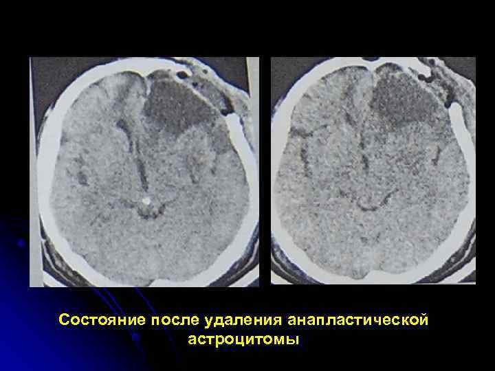 Состояние после удаления анапластической    астроцитомы 