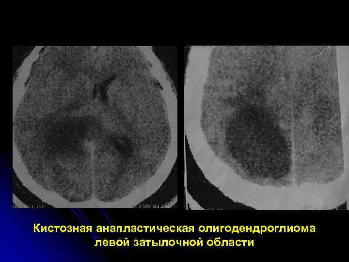 Кистозная анапластическая олигодендроглиома  левой затылочной области 