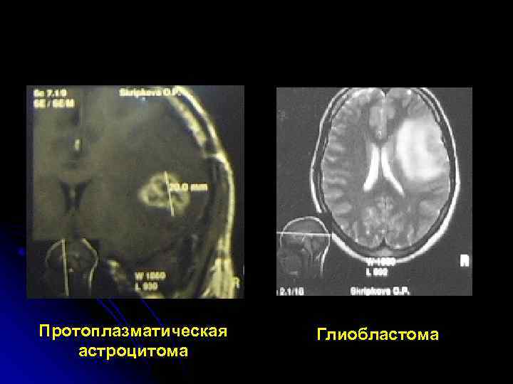 Протоплазматическая  Глиобластома астроцитома 