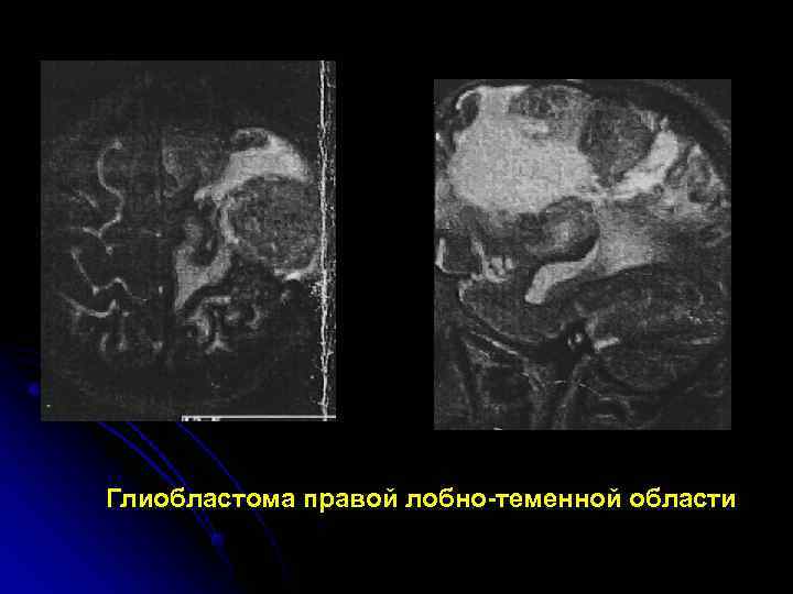 Глиобластома правой лобно-теменной области 