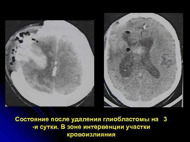 Состояние после удаления глиобластомы на 3 -и сутки. В зоне интервенции участки  
