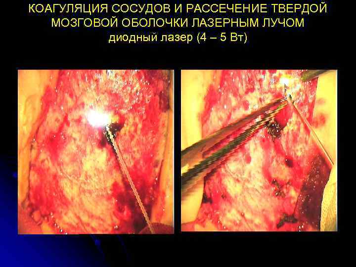 КОАГУЛЯЦИЯ СОСУДОВ И РАССЕЧЕНИЕ ТВЕРДОЙ  МОЗГОВОЙ ОБОЛОЧКИ ЛАЗЕРНЫМ ЛУЧОМ  диодный лазер (4
