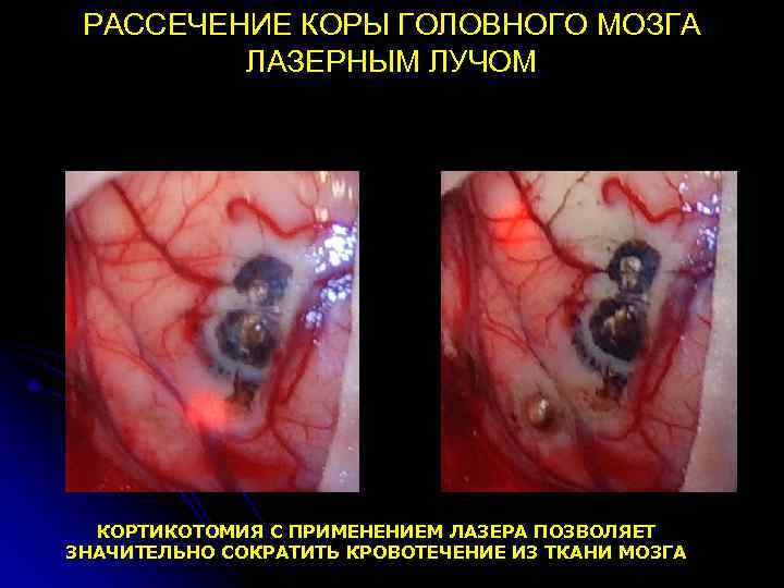  РАССЕЧЕНИЕ КОРЫ ГОЛОВНОГО МОЗГА   ЛАЗЕРНЫМ ЛУЧОМ  КОРТИКОТОМИЯ С ПРИМЕНЕНИЕМ ЛАЗЕРА