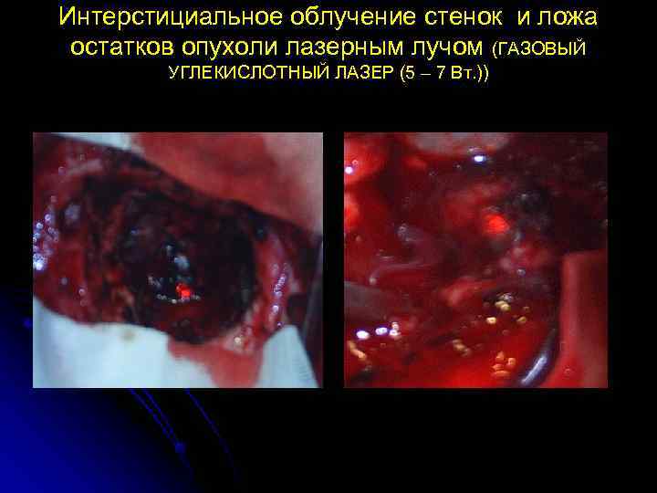 Интерстициальное облучение стенок и ложа остатков опухоли лазерным лучом (ГАЗОВЫЙ   УГЛЕКИСЛОТНЫЙ ЛАЗЕР