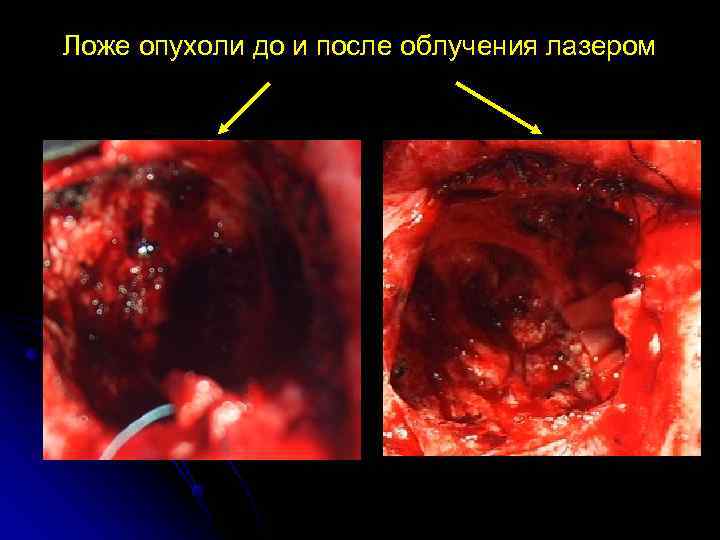Ложе опухоли до и после облучения лазером 