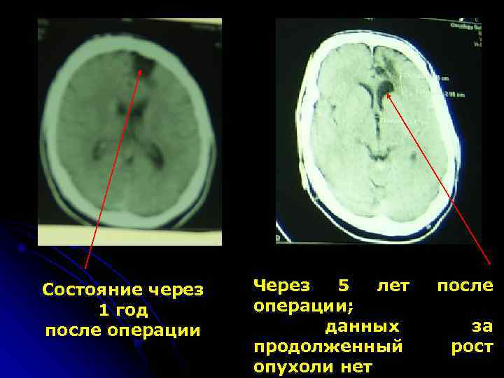 Состояние через  Через  5  лет  после 1 год  операции;