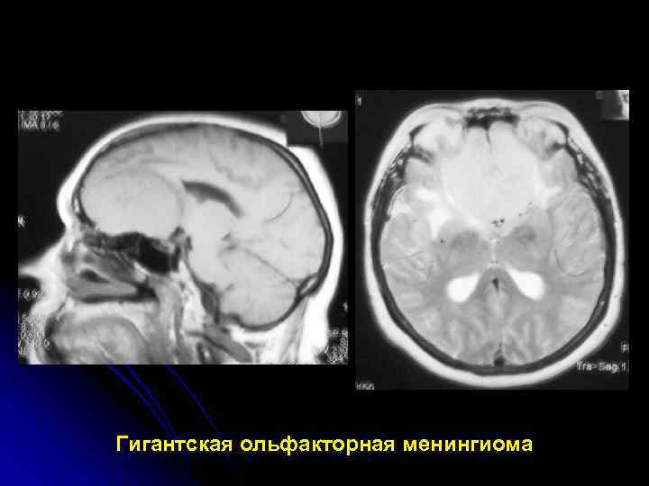 Менингиома головного мозга продолжительность операции. Ольфакторная ямка менингиома. Менингиома ольфакторной ямки кт. Менингиома ольфакторной ямки мрт.