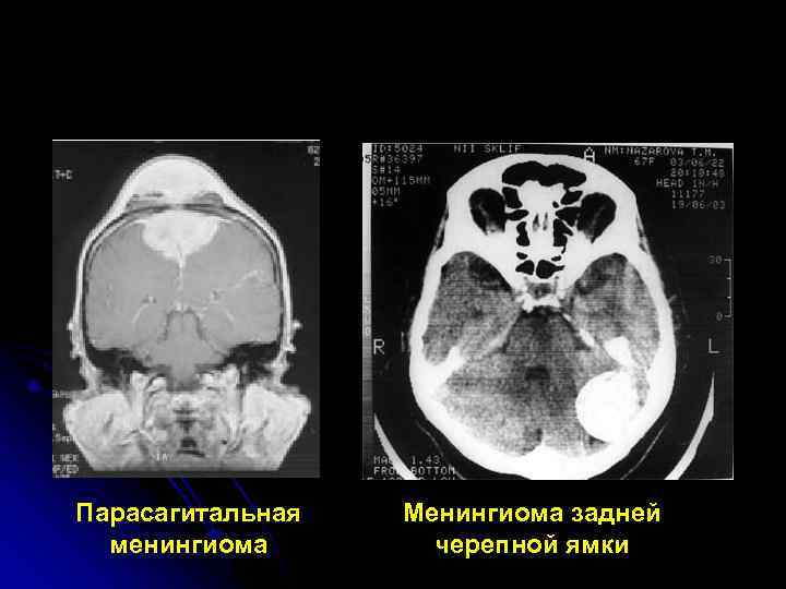 Парасагитальная  Менингиома задней  менингиома  черепной ямки 