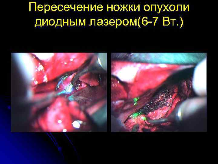 Пересечение ножки опухоли диодным лазером(6 -7 Вт. ) 