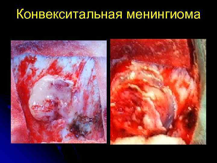 Конвекситальная менингиома 