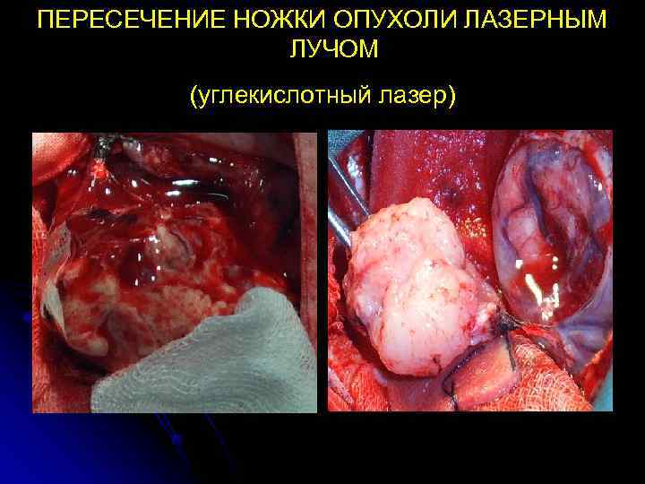 ПЕРЕСЕЧЕНИЕ НОЖКИ ОПУХОЛИ ЛАЗЕРНЫМ    ЛУЧОМ   (углекислотный лазер) 