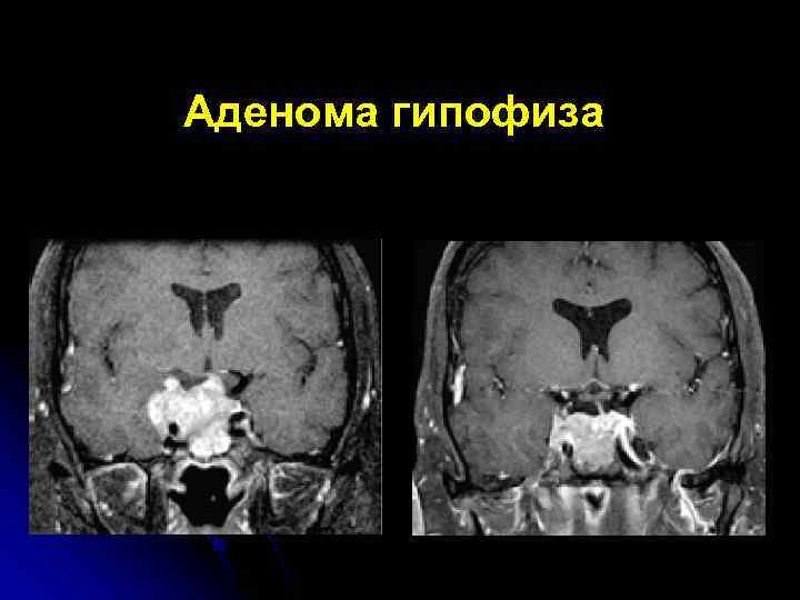 Аденома гипофиза 