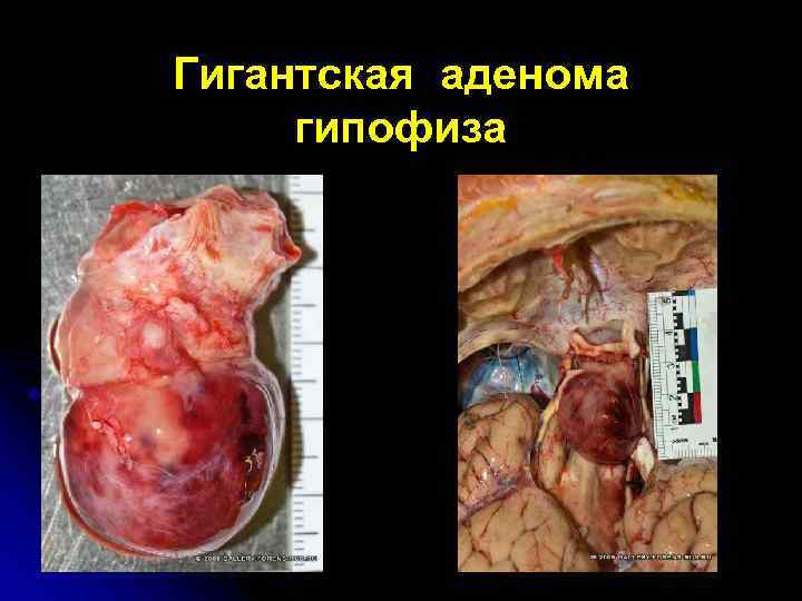 Гигантская аденома гипофиза 