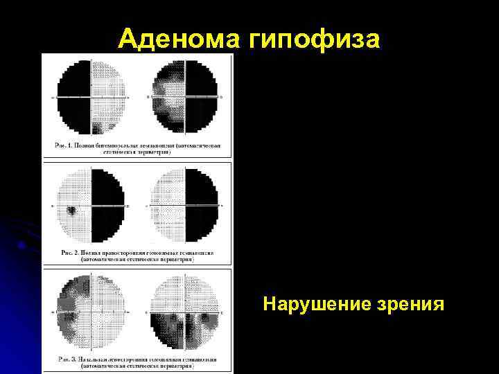 Аденома гипофиза   Нарушение зрения 
